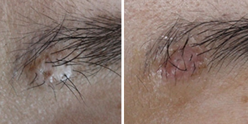 눈썹점 제거 수술 전 눈썹 한가운데 돌출점 비교 사진