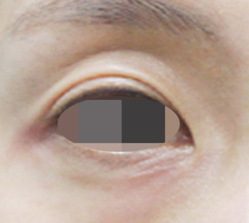 눈꺼풀 필러 시술 전 한쪽 눈 확대 사진