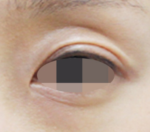 눈꺼풀 필러 시술 전 한쪽 눈 확대 사진