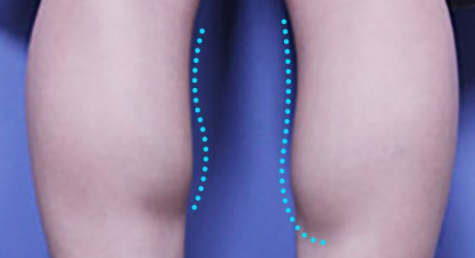 두툼한 비복근 사진