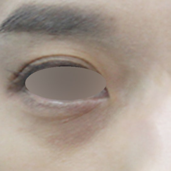 눈밑꺼짐필러 시술 전 눈밑 굴곡과 음영 확대 사진