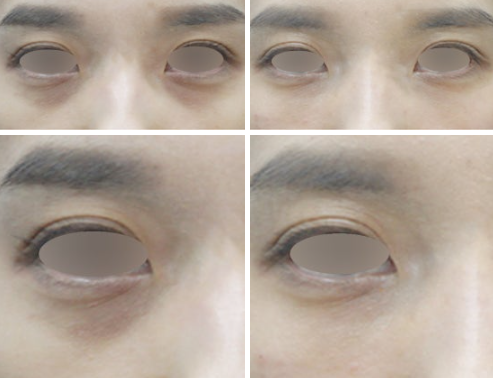 눈밑꺼짐필러 시술 전 눈밑 꺼짐과 그림자형 다크서클 정면 비교 사진