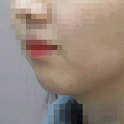 턱끝필러 전후, 턱끝만 채우지 않았던 무턱 환자 후기 대표 이미지