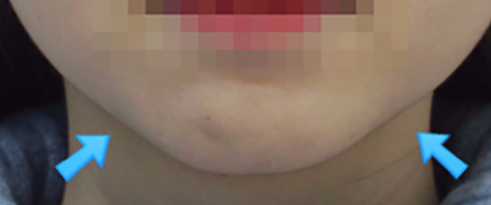 턱필러 시술 전 턱끝 좌우의 패인 부위와 정면 턱선 사진