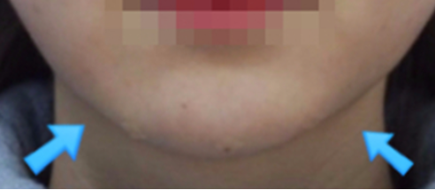 턱필러 시술 직후 턱끝 좌우 볼륨과 정면 턱선 변화 사진