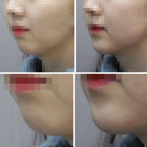 무턱 턱필러 시술 전 입술 라인보다 뒤에 위치한 턱끝 측면 비교 사진